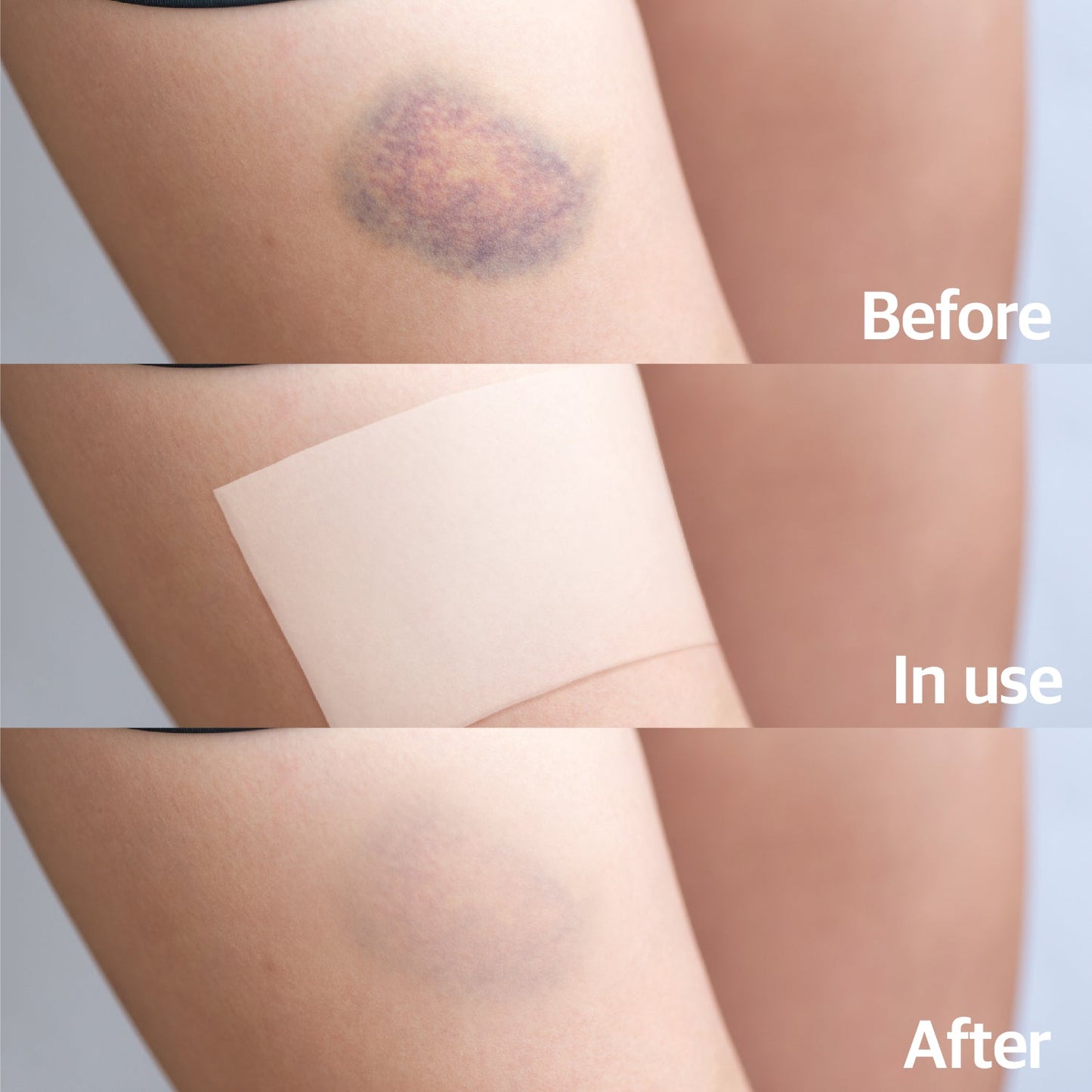 Arni patch for Pain, Bruise, Swelling (1 Pack of 5 Patches) - Laboflex -